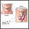 Parathyroidectomy