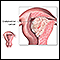 Endometrial cancer