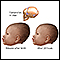 Newborn head molding