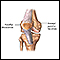 Patellar dislocation