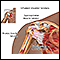 Inflamed shoulder tendons